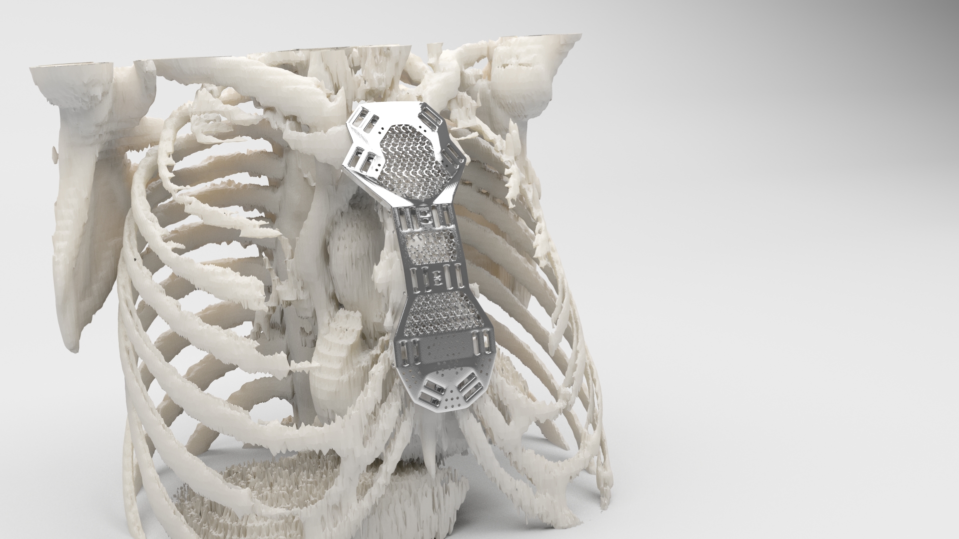 Implante a medida 3D de esternón
