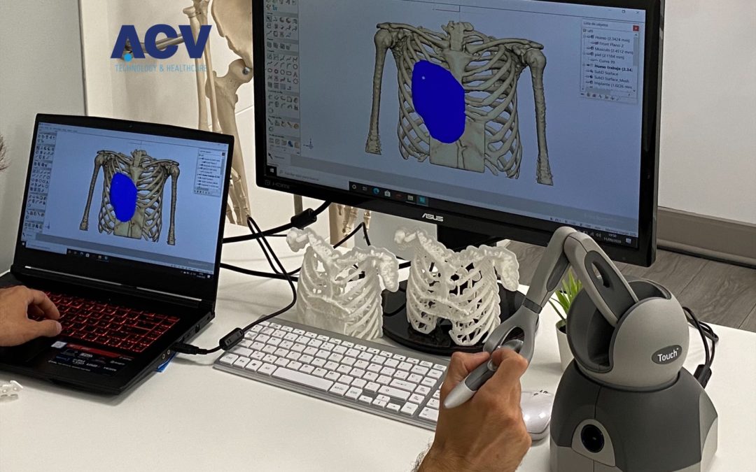 Creación de implantes torácicos con la más avanzada tecnología 3D